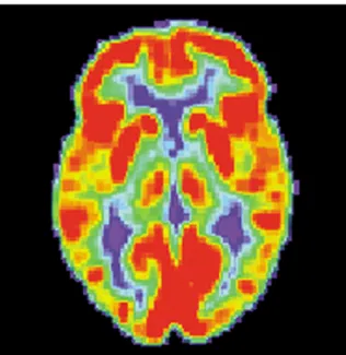 Illustration 10: Exemple d'Imagerie Isotopique PET : imagerie cérébrale au 18FDG