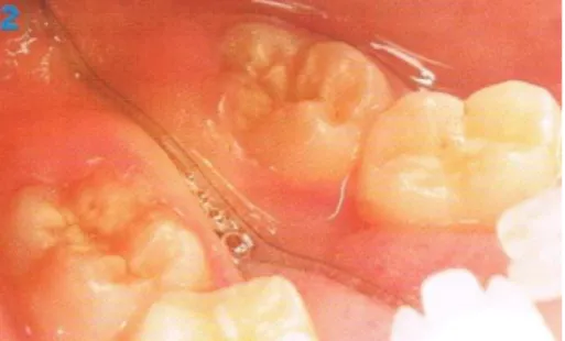 Fig. : 2.8. Éruption de dent à risque carieux élevé : deuxième molaire mandibulaire présentant des sillons  anfractueux et une hypominéralisation de l'émail (Droz et al., 2004) 
