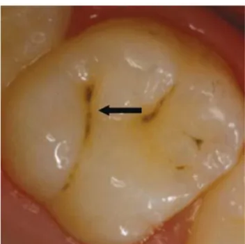 Fig. : 2.9. Lésion carieuse qualifiée de non-cavitaire dont le scellement est indiqué selon les  recommandations de l'ADA (Beauchamp et al., 2008)