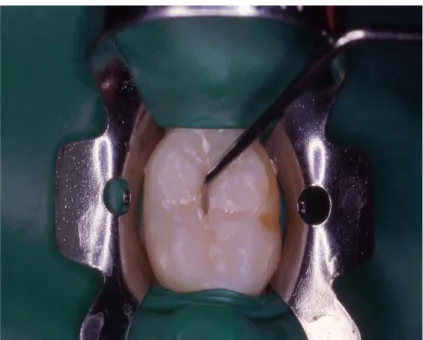 Fig. : 2.13. Isolation de la dent à sceller par la pose du champ opératoire (photo du département  d'Odontologie pédiatrique de Brest)