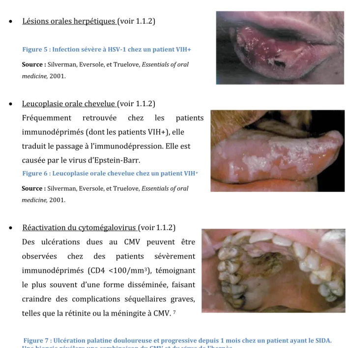 Figure 6 : Leucoplasie orale chevelue chez un patient VIH + Source : Silverman, Eversole, et Truelove, Essentials of oral  medicine, 2001