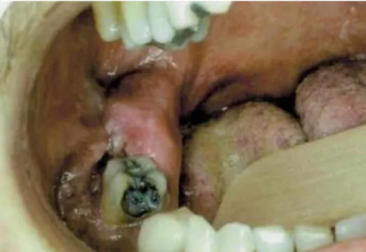Figure 9 : Un « abcès dentaire » ne  répondant pas au traitement, chez un  patient VIH+, s’étant révélé être un  LNH
