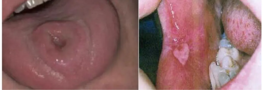 Figure 19 : Chancre syphilitique primaire 