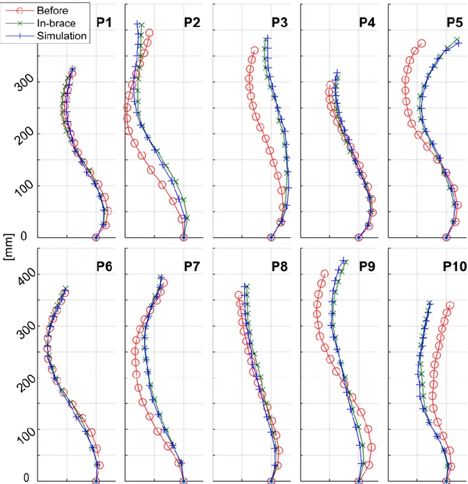 Fig.  3  Vertebral  positions  and  spine  midlines  before  treatment,  in-brace  and  in  simulated  geometry: 