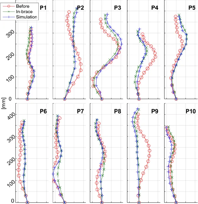 Fig.  4  Vertebral  positions  and  spine  midlines  before  treatment,  in-brace  and  in  simulated  geometry: 