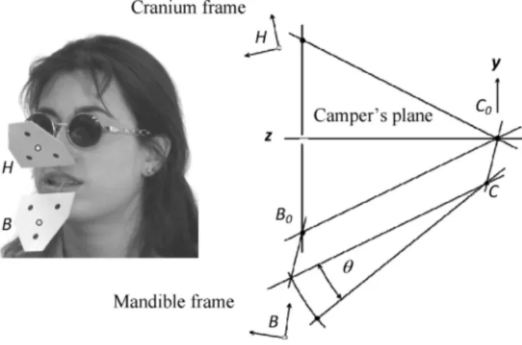 Fig. 2. Prosthesis and deﬁnition of slope angle.