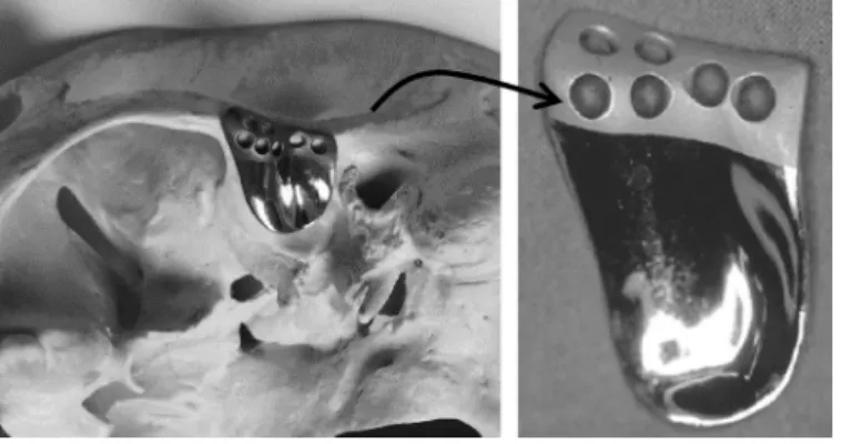 Fig. 6. Temporal plate (TMJ Medical).