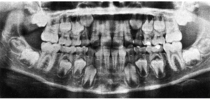 Figure 3 : Radiographie panoramique d’un garçon de 10 ans. 