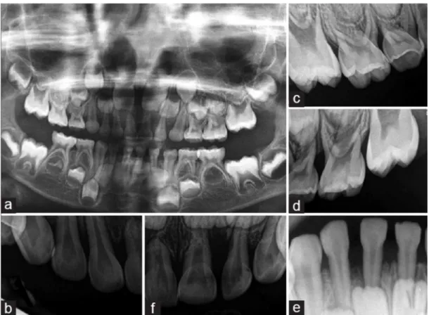 Figure 6 : a) Radiographie panoramique d’un garçon âgé de 5 ans atteint d’une parodontite  agressive localisée