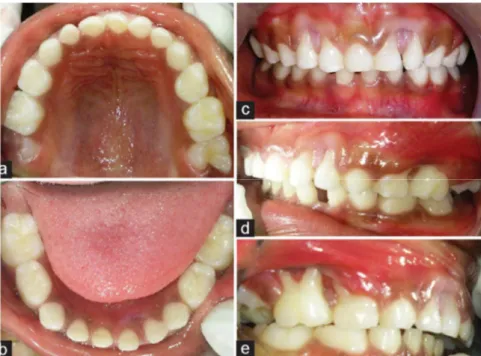 Figure 7 : Photographies intra-buccales d’un garçon âgé de 5 ans atteint d’une parodontite  agressive localisée