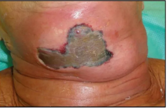 Figure 7 : Fasciite nécrosante cervicale 