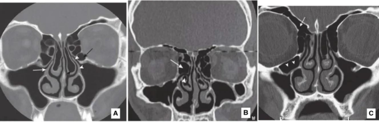 Figure 7 : Tomodensitométrie (TDM) des variations anatomiques concernant le cornet nasal moyen,  le processus unciforme et les cellules ethmoïdales :                                                                                      A : Coupe frontale pa