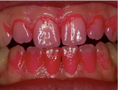 Figure 3 : Mise en évidence de plaque dentaire par utilisation d'un indicateur de plaque 