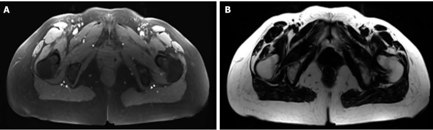 Figure 1  Example of water (A) and fat (B) images with Dixon methods on a 64-year-old female adult spinal deformity patient.