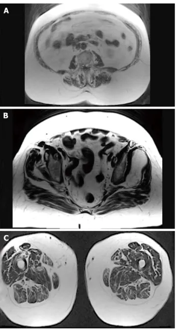 Figure 5  Magnetic resonance imaging samples (A: Lumbar area; B: 