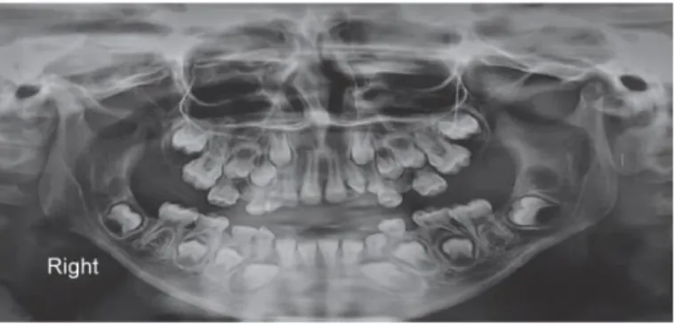 Figure 1.12 : Radiographie panoramique d’un patient âgé de 8 ans, atteint d’une fibromatose gingivale  non syndromique