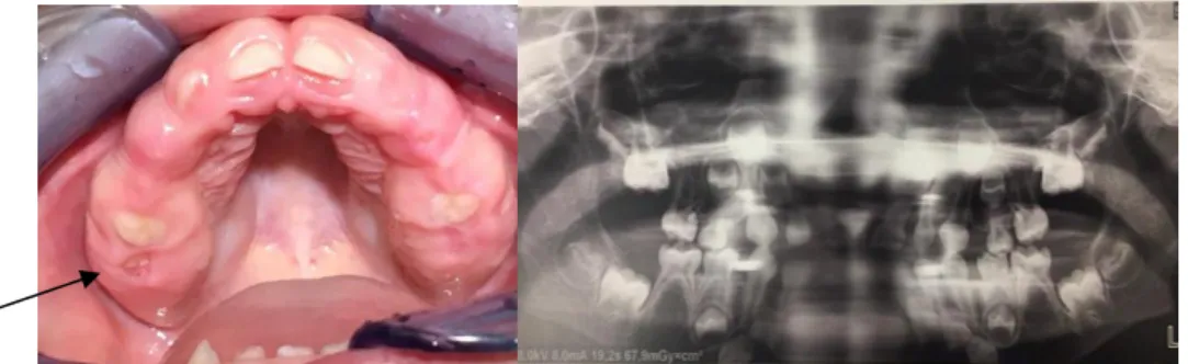 Figure 1.18: Photographie et panoramique dentaire, CHRU Brest. Patiente de 5 ans et demi, atteinte  d’une FG
