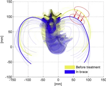 Figure 2 shows an example of displacements applied to the model to simulate the orthosis action on a rib