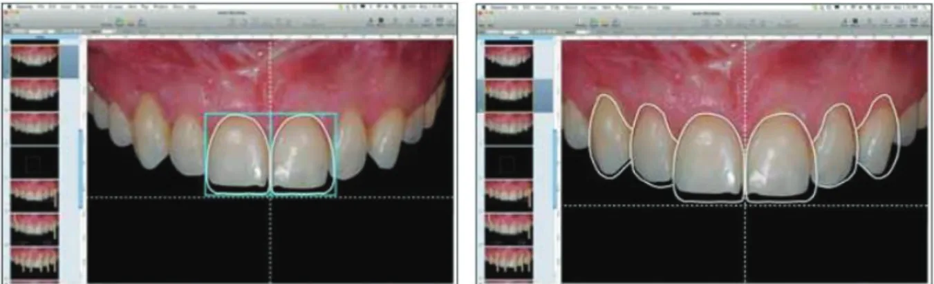 Fig 41 : Dessin du contour des dents guidé par la croix et la proportion rectangulaire  (Coachman and Calamita, 2012) 