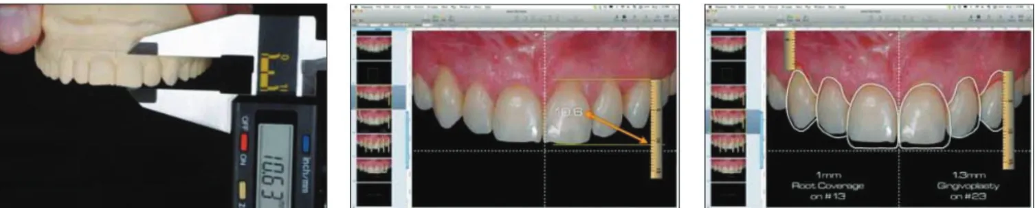 Fig 45 et 46 : Calibrage de la longueur de l’incisive avec la règle digitale du logiciel (Coach- (Coach-man and Calamita, 2012) 