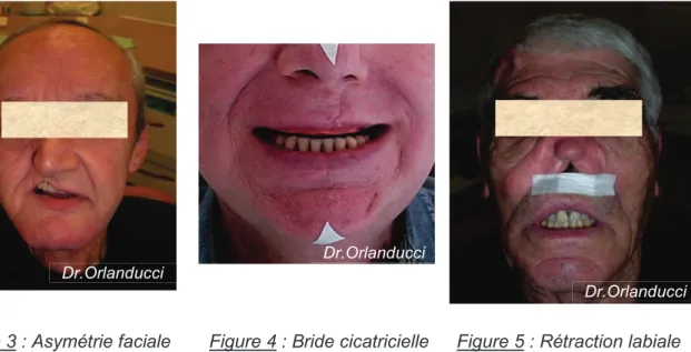 Figure 3 : Asymétrie faciale  Figure 4 : Bride cicatricielle  Figure 5 : Rétraction labiale 