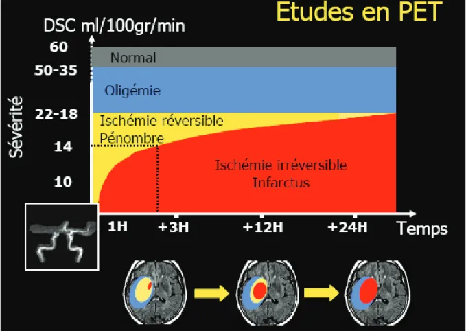 Figure  1 :  Evolution  en  fonction  du  temps  des  composantes  ischémiques  réversibles  (pé- (pé-nombre) et irréversibles (infarctus) suite à une occlusion artérielle à visée cérébrale