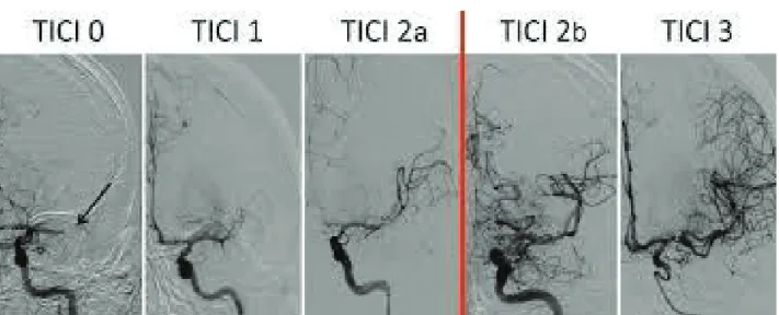 Figure 2 : Score modifié Thrombolysis In Cerebral Infarction (mTICI) estimé par un neurora- neurora-diologue interventionnel sur l’artériographie pré et post-thrombectomie mécanique.