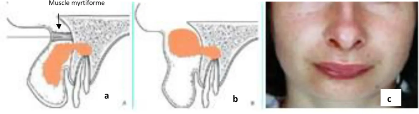 Figure 7 : Cellulite naso-labiale  [3]  (a : diffusion vers la lèvre supérieure, b: diffusion vers le nez, c: vue clinique) 