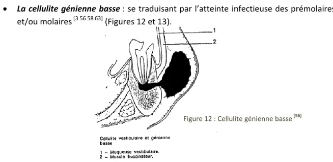 Figure 12 : Cellulite génienne basse  [56]