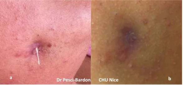 Figure 15 : Cellulite cervico-faciale avec, a : fistule et b : cicatrise suite à cette fistule (collection  Dr Pesci-Bardon Catherine)