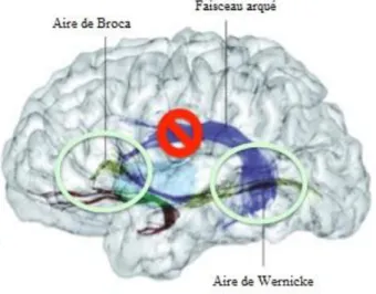 Figure 1: Lésion du faisceau arqué : aphasie de conduction,  https://elodieventura.wordpress.com/category/sciences-cognitives/aphasie 