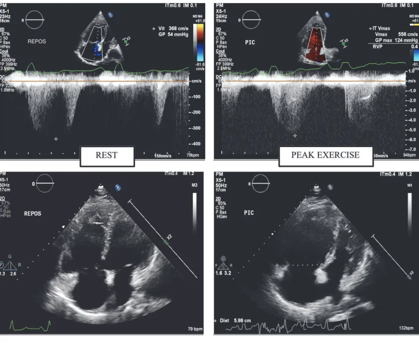 FIGURE 6: comparison between echocardiography at rest and peak exercise in a PAH patient: 
