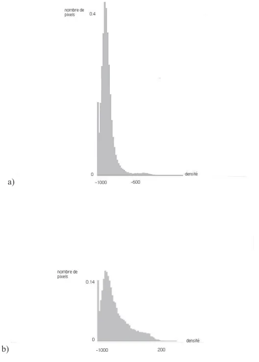 Figure 1: Histogrammes de densité pulmonaire scanographique: (a): Chez un sujet sain, l’histogramme de  densité est pointu et dévié vers la gauche (un grand nombre de pixels se situe entre des densités normales  de -900 à -700 HU)