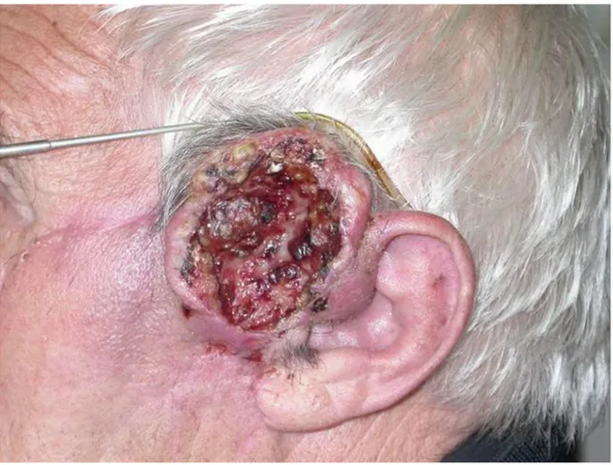 Figure  1 :  Carcinome  épidermoïde  cutané  de  forme  ulcéro-végétante,  de  localisation  pré- pré-tragienne gauche