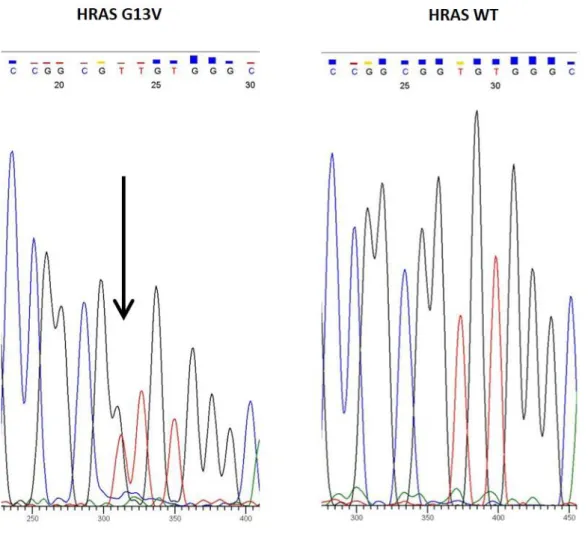 Figure 1: Direct sequencing (Sanger method) of DNA showing a heterozygous HRAS G13V  point—mutation (left panel)