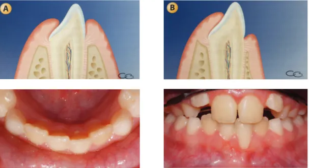 Figure 5 Répartition inégale de tissus parodontaux selon la position des dents lors de leur éruption