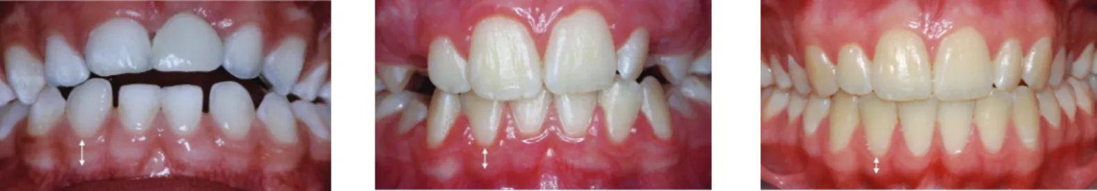 Figure 7 Évolution de la gencive chez une patiente au cours des différents stades de dentition (documents Dr Dridi, université Nice Sophia Antipolis).