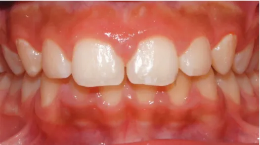 Figure 8 L'accroissement gingival induit par la plaque. Il peut être localisé, généralisé