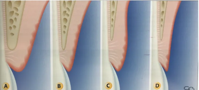 Figure 14 Classification de Maynard et Wilson: type I (A), type II (B), type III (C), type IV (D)  (document Dr Borhetti (1))