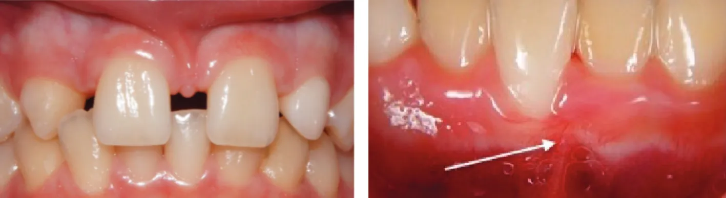 Figure 15 Insertion défavorable de freins vestibulaires: insertion sur la crête (à gauche) et exerçant une traction sur la gencive libre (à droite) (document Dr Dridi, université Nice Sophia Antipolis)