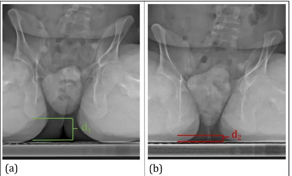Figure 1 : Experimental sagging of the pelvis computed as d 2 -d 1