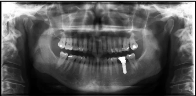 Fig. 38. Orthopantomogramme de la patiente réalisé lors de la première consultation. 