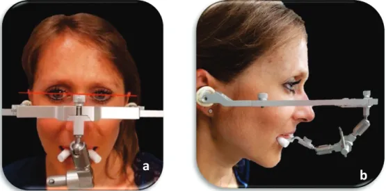 Fig 9.Enregistrement avec l’arc facial de la position du maxillaire par rapport au PAO : vues de face (a) et de  profil (b)