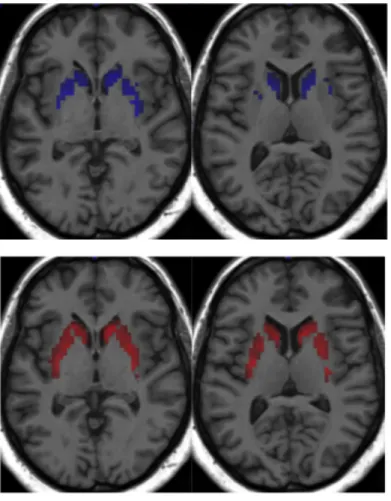 Figure 2 – Segmentation of the dorsal striatum with AAL (blue), segmentation of the dorsal  striatum with Freesurfer (red) 