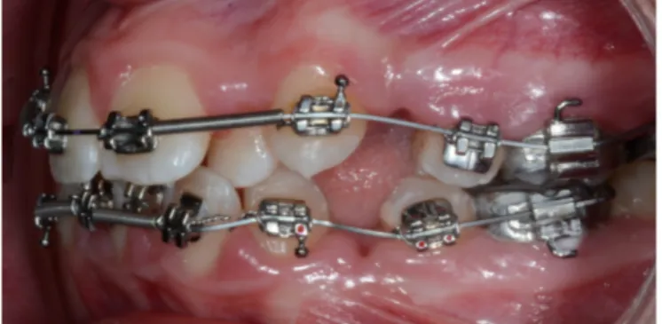 Figure 1 : Patient en début de traitement, avec des arcs orthodontiques continus en Nickel-Titane