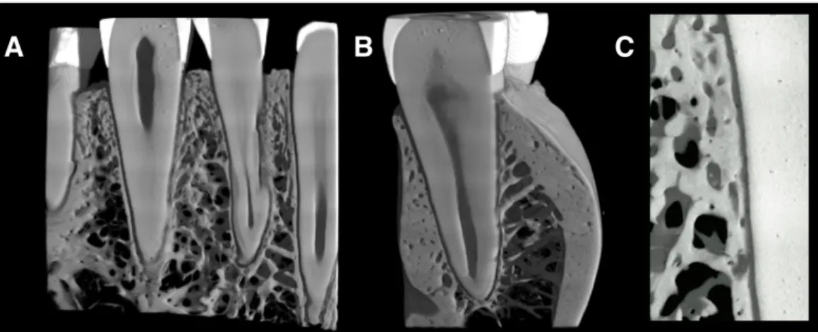 Figure 12 : Acquisitions SRµCT d’un donneur de 19 ans : A, coupe mésio-distale ; B, coupe vestibulo- vestibulo-linguale ; C, détail de l’interface os alvéolaire - LAD - dent  