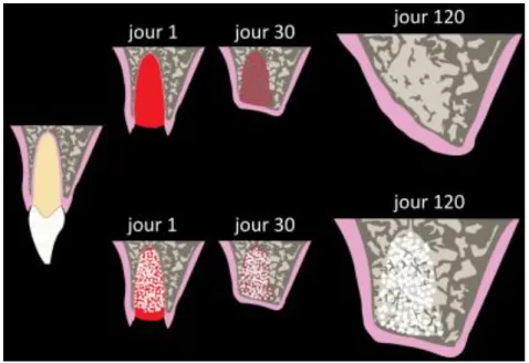 Figure 6 : Schéma comparant l’évolution du volume alvéolaire post-extractionnel sans (en haut) et  avec (en bas) comblement 