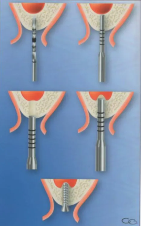 Figure 8 : Schéma illustrant la technique de Summers 