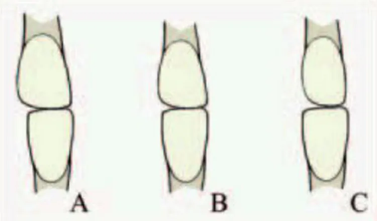 Figure 5 : Rapport de l’incisive latérale maxillaire par rapport à l’incisive latérale mandibulaire 