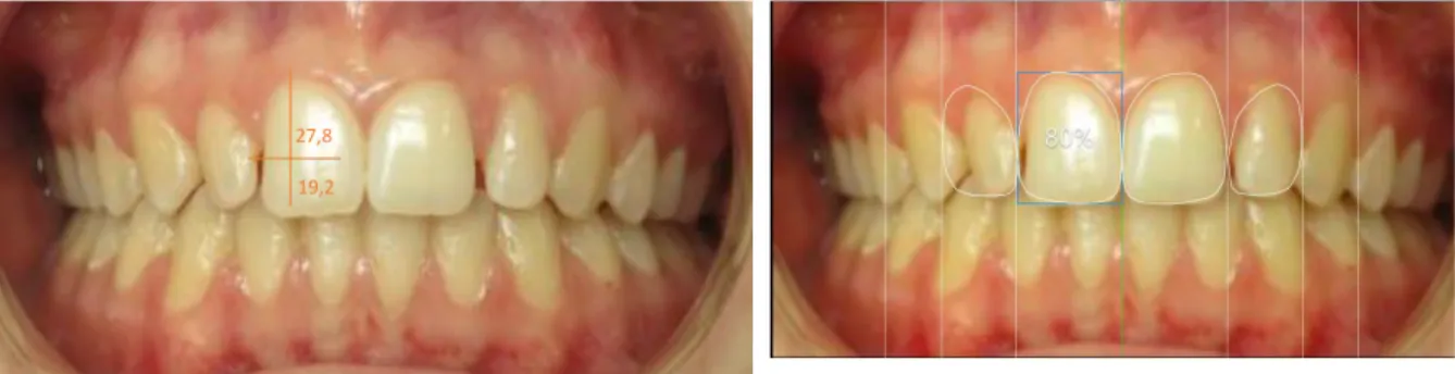 Figure 6 : Incisives latérales riziformes et coronoplasties additives sur 12-11-21-22 